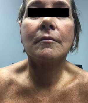 Facelift