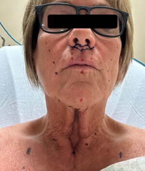 Facelift