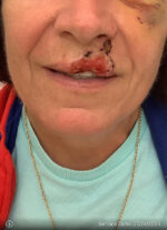 Facial Reconstruction