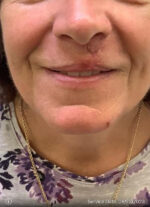 Facial Reconstruction