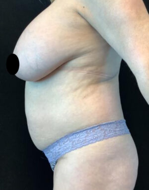 Breast Implant Removal