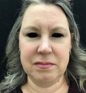 Upper Eyelid Blepharoplasty