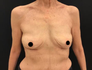 Breast Implant Removal