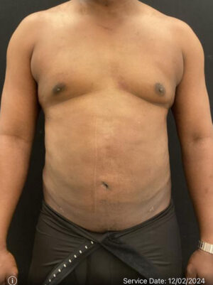 Liposuction for Men