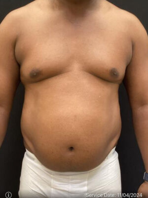 Liposuction for Men