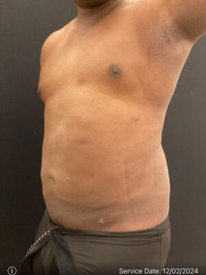 Liposuction for Men