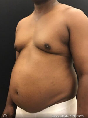 Liposuction for Men