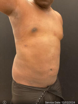 Liposuction for Men