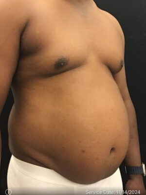 Liposuction for Men
