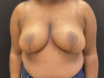Breast Reduction