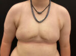 Breast Reduction