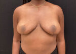 Breast Reduction