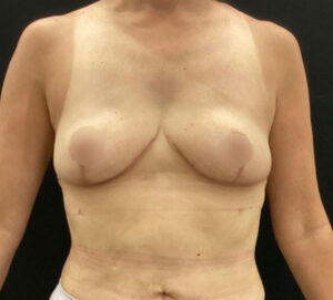Breast Reduction