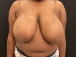 Breast Reduction