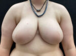 Breast Reduction