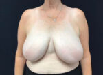 Breast Reduction