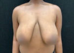 Breast Reduction