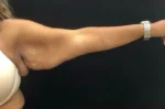 Brachioplasty