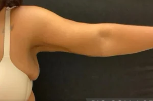 Brachioplasty
