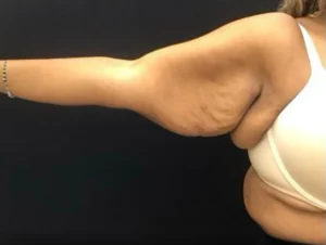 Brachioplasty