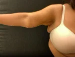 Brachioplasty