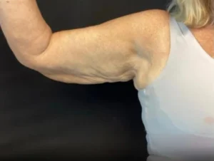 Brachioplasty