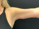 Brachioplasty