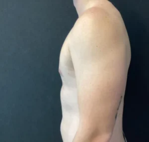 Gynecomastia