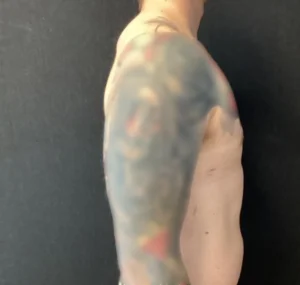 Gynecomastia