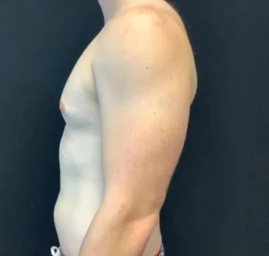 Gynecomastia