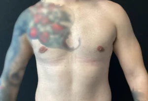 Gynecomastia