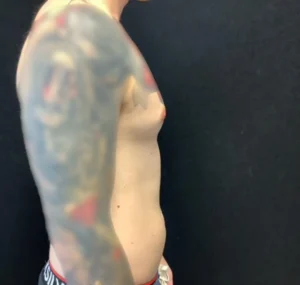 Gynecomastia