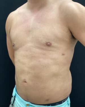 Gynecomastia