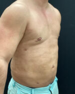 Gynecomastia