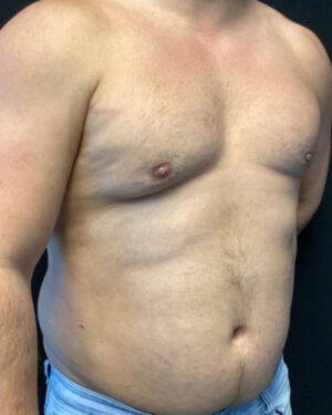 Gynecomastia