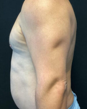 Gynecomastia