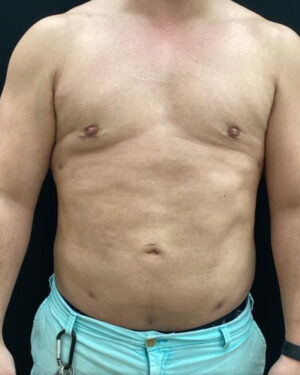 Gynecomastia