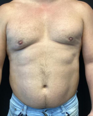 Gynecomastia
