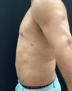 Gynecomastia