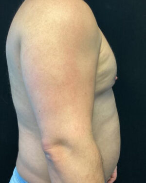 Gynecomastia
