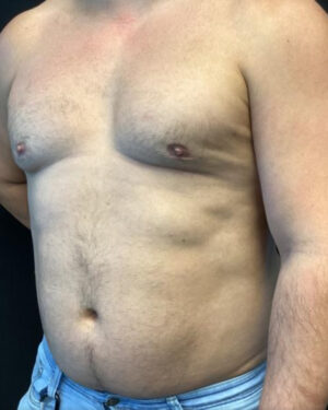 Gynecomastia