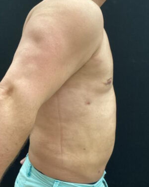 Gynecomastia