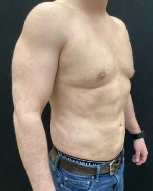 Gynecomastia