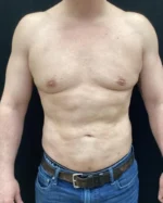 Gynecomastia