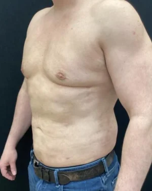 Gynecomastia