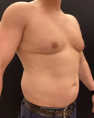 Gynecomastia