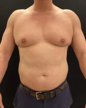 Gynecomastia