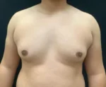Gynecomastia