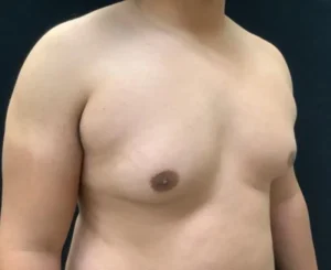 Gynecomastia