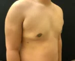 Gynecomastia